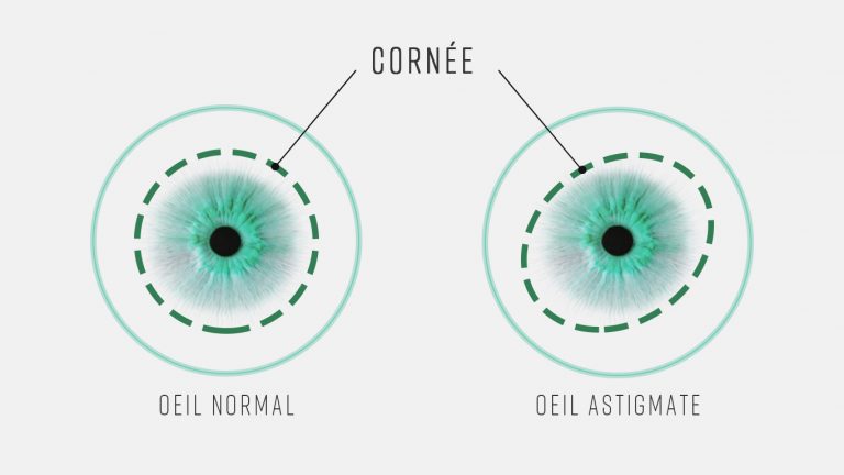 Oeil astigmate et oeil normal