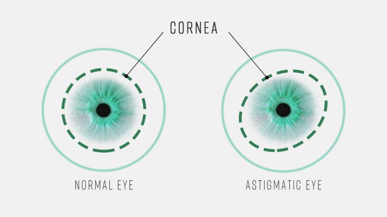 Astigmatism