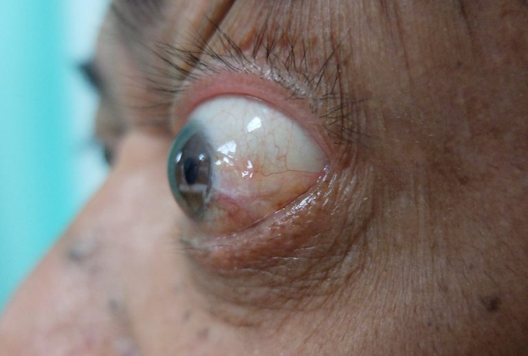 Proptose ou exophtalmie