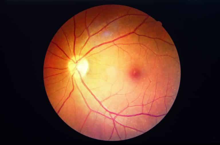 Macular Degeneration