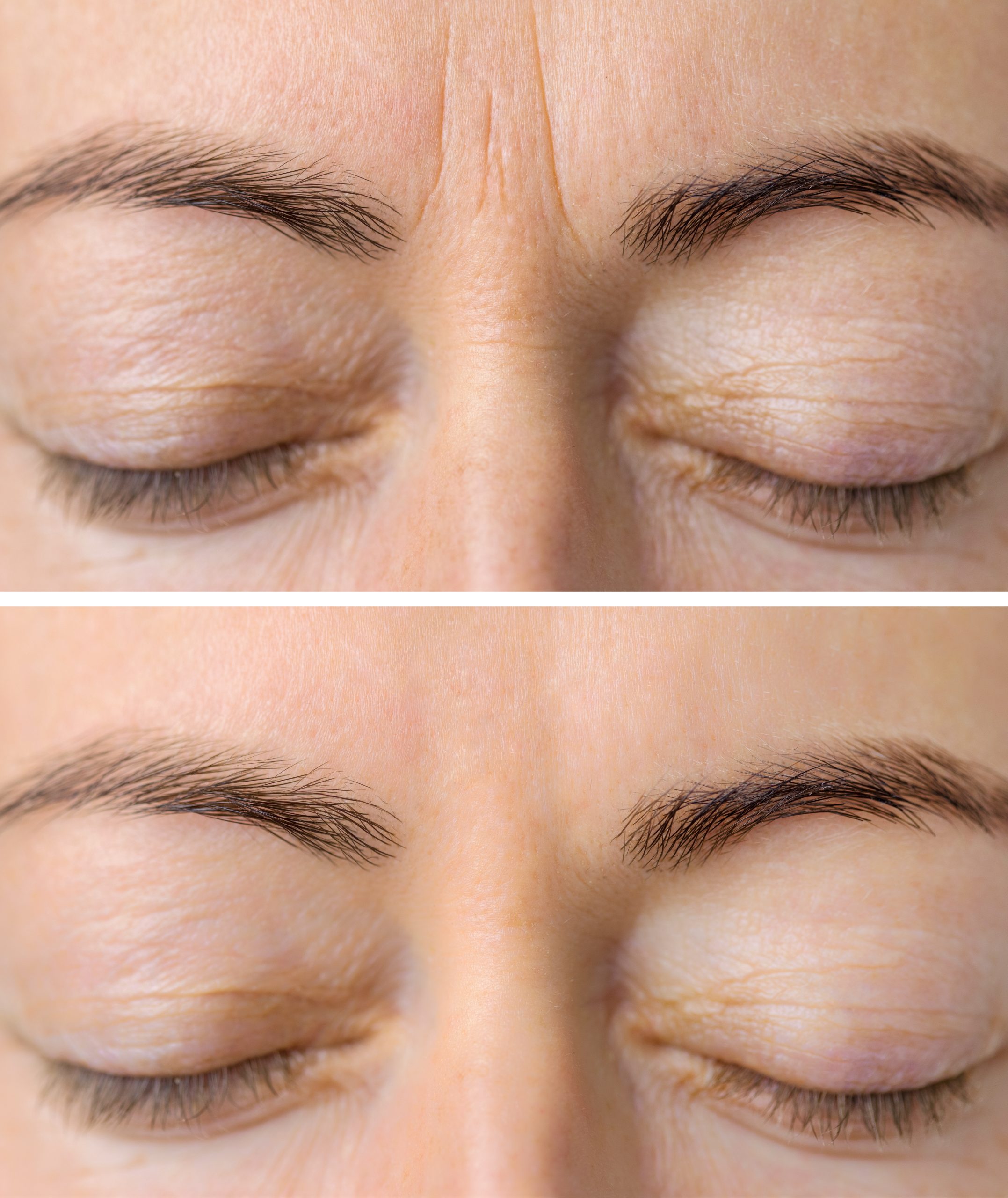 Woman's face skin before and after aesthetic beauty cosmetic procedures with removed skin wrinkles