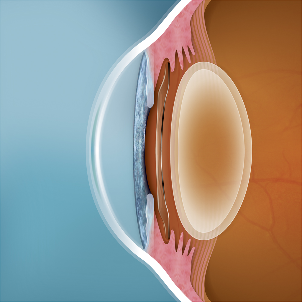 Lentille EVO ICL placée derrière l'iris