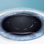 Lentille EVO ICL dans l'œil