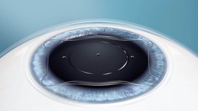 Lentille EVO ICL dans l'œil