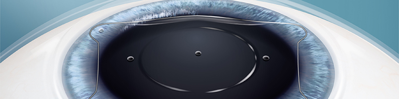 Lentille EVO ICL
